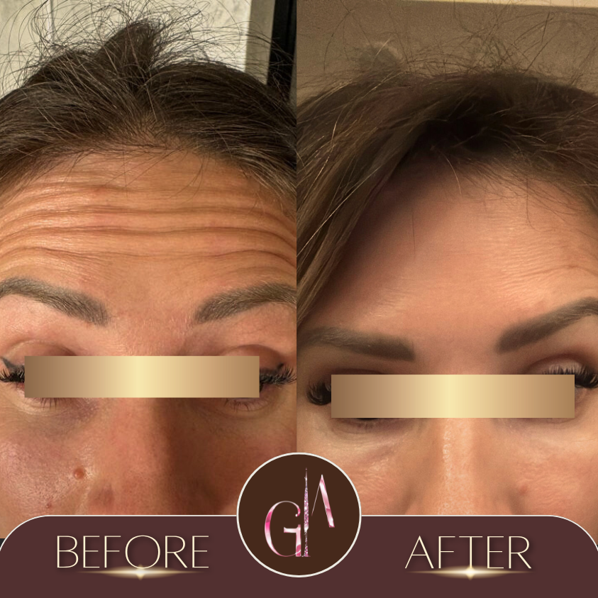 Non-surgical Rhinoplasty 