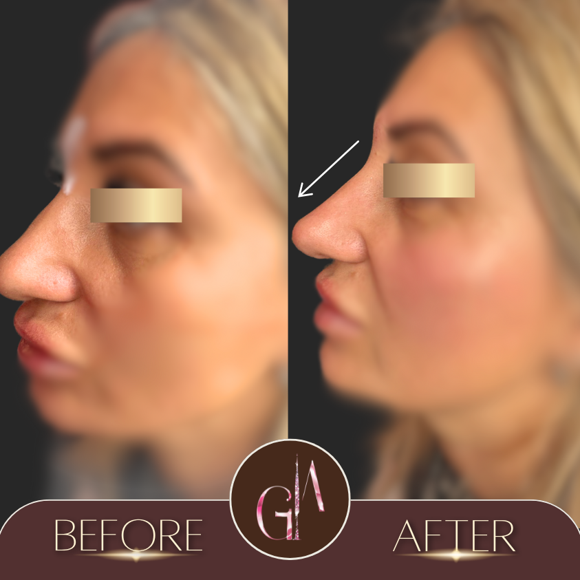 Non-surgical Rhinoplasty 