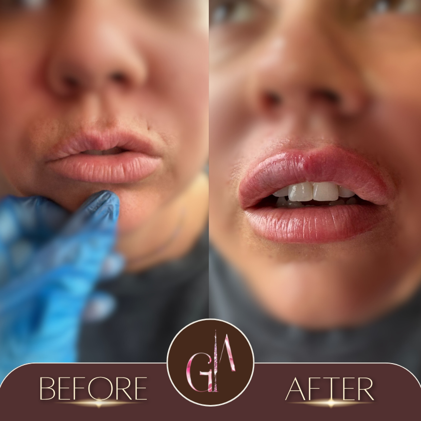 Non-surgical Rhinoplasty 