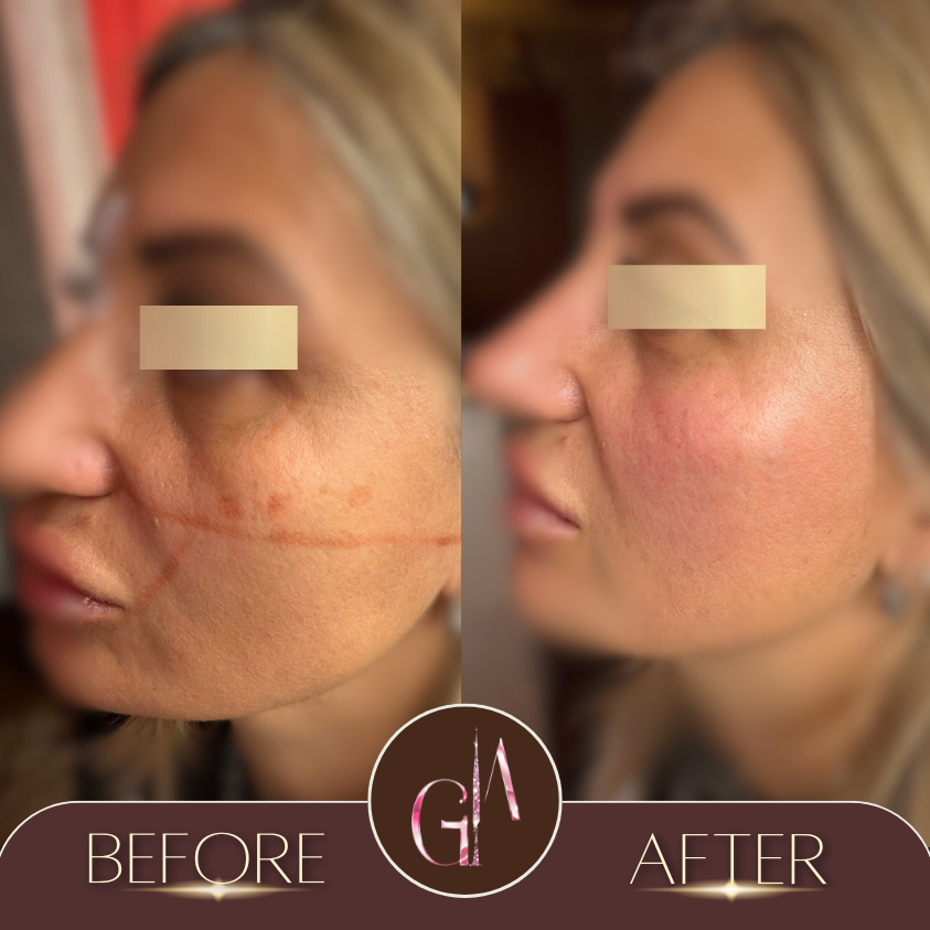 Non-surgical Rhinoplasty 