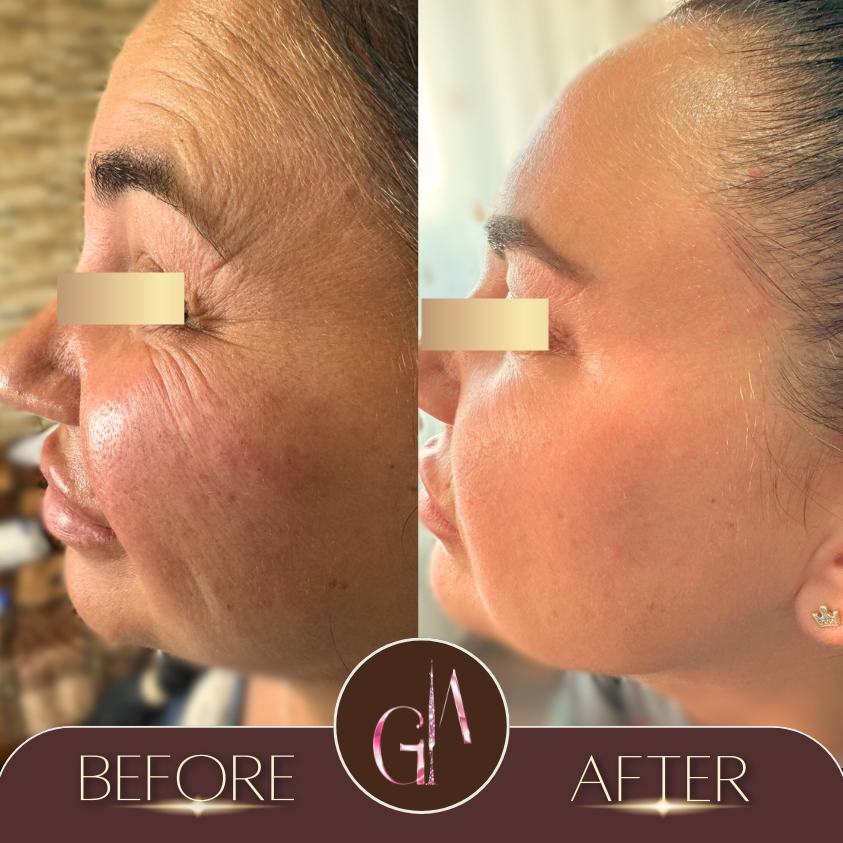 Non-surgical Rhinoplasty 