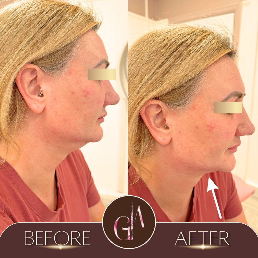 Non-surgical Rhinoplasty 