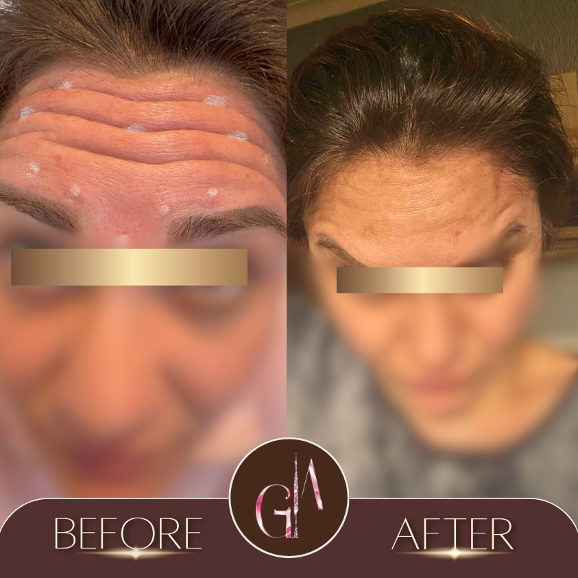 Non-surgical Rhinoplasty 