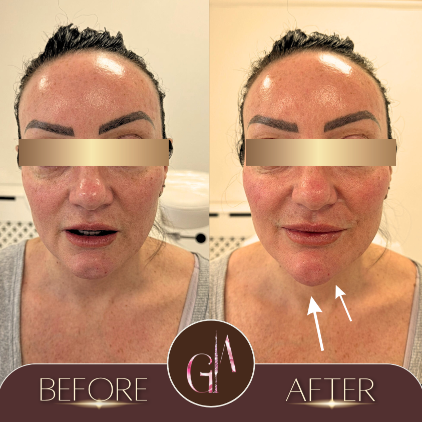 Non-surgical Rhinoplasty 
